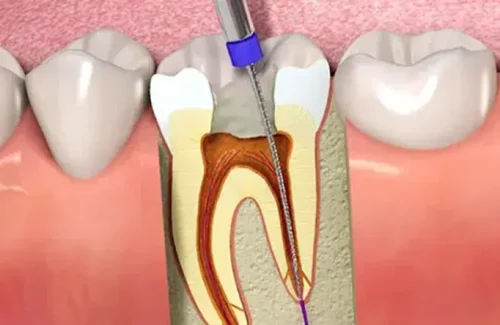 2254-clinica-dental-stoma-alcorcon-y-mostoles-endodoncia-1