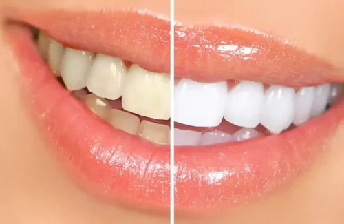 tipos-de-blanqueamiento-dental1-1080x675-2-1024x640